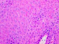 Non-cancerous tissue from a benign oral tumor. Image courtesy of Angela Yoon